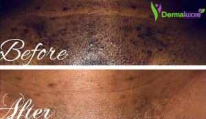 How to reduce Ingrown Hair