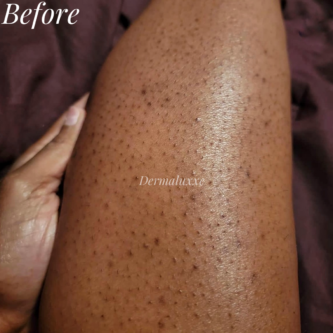 Keratosis pilaris treatment nigeria strawberry skin Lagos