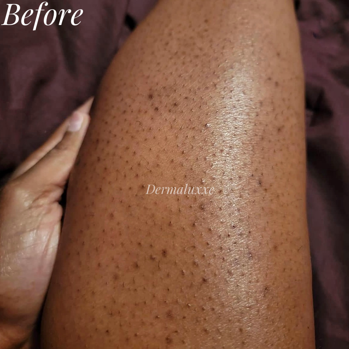 Keratosis pilaris treatment nigeria strawberry skin Lagos